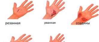 Что делать если гипсовая лангета дала трещину? Правила ухода и ремонта