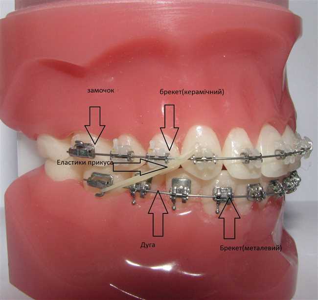 Какие металлы используются в зубных протезах и брекетах?